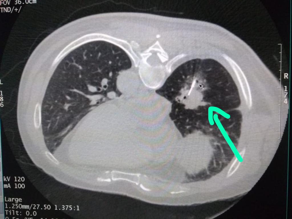 CT guided lung biopsy Infinity Intervention Clinic