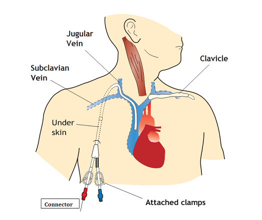 Port or PICC Line Placement - Vein & Endovascular Medical Care