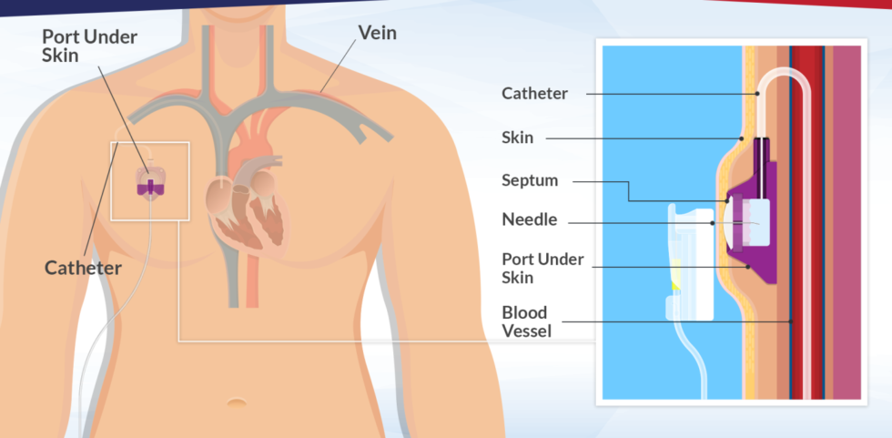 By placing catheters below the marked bra line, catheters are not